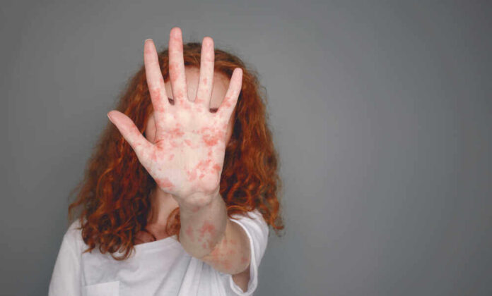 Stop,Measles.,Woman,With,Red,Spots,On,Palm,Over,Grey